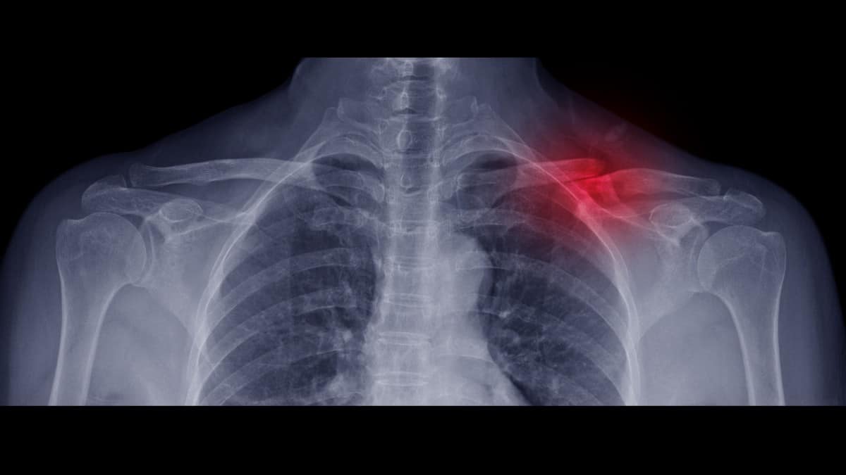 Arm Numbness and Other Side Effects of a Broken Collarbone