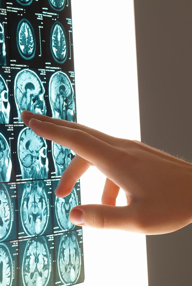 Brain injury Brain injury