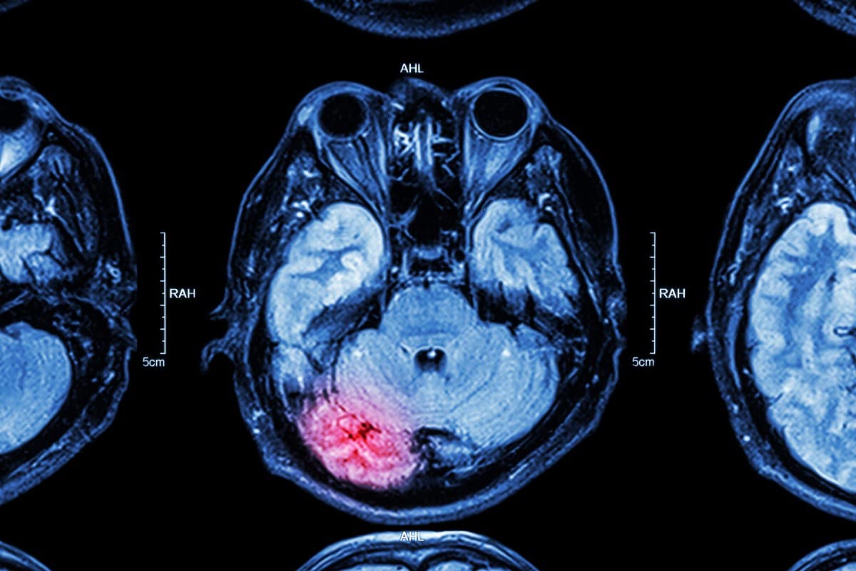 Traumatic Brain Injuries from a Car Accident in Kansas City